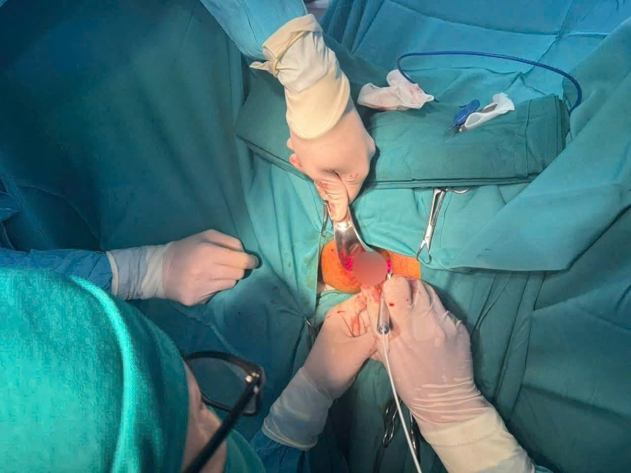  Điều trị bệnh trĩ độ III bằng công nghệ Laser: Giải pháp ít xâm lấn, phục hồi nhanh tại Bệnh viện Đa khoa Hòa Bình