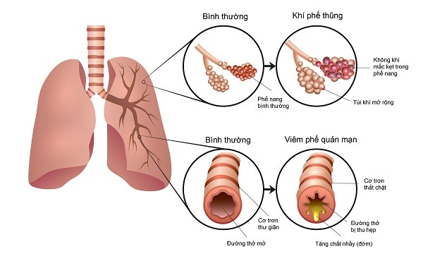  Dinh dưỡng đối với bệnh phổi tắc nghẽn mạn tính